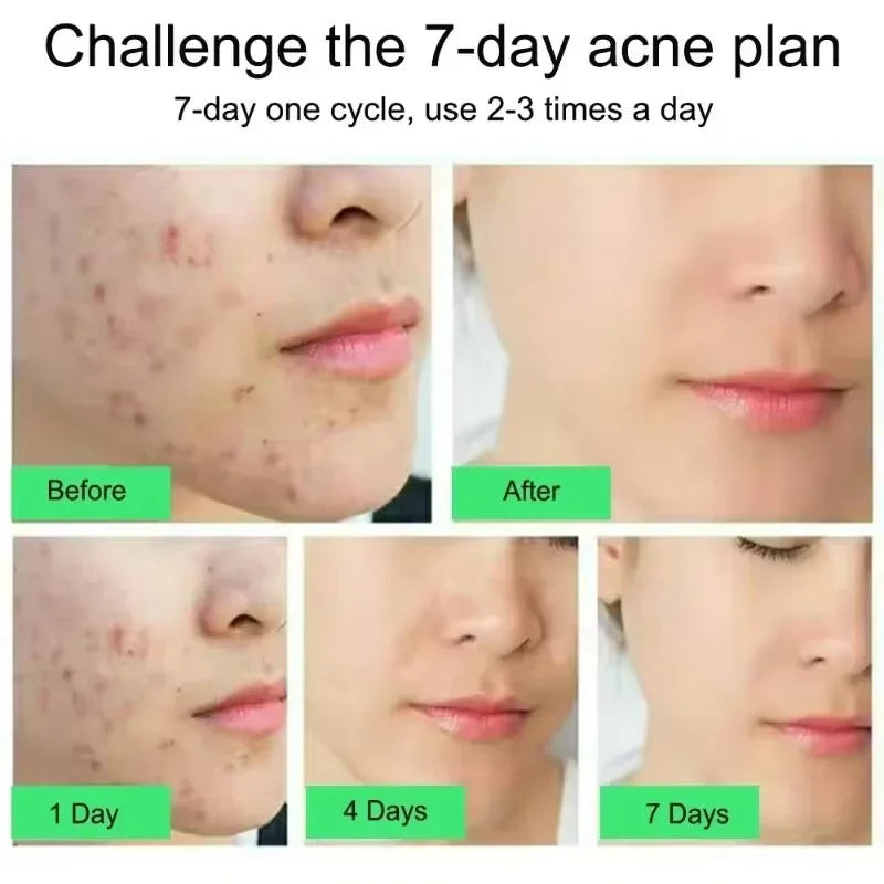 Clarifying Salicylic Acid Cleanser - Deep Acne & Pore Purifying Wash