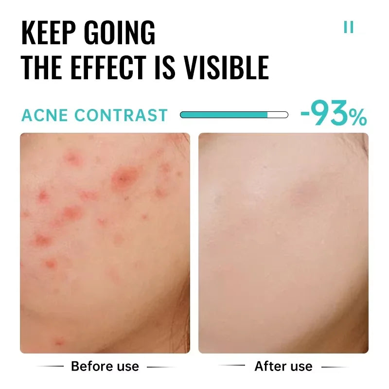 Clarifying Salicylic Acid Cleanser - Deep Acne & Pore Purifying Wash