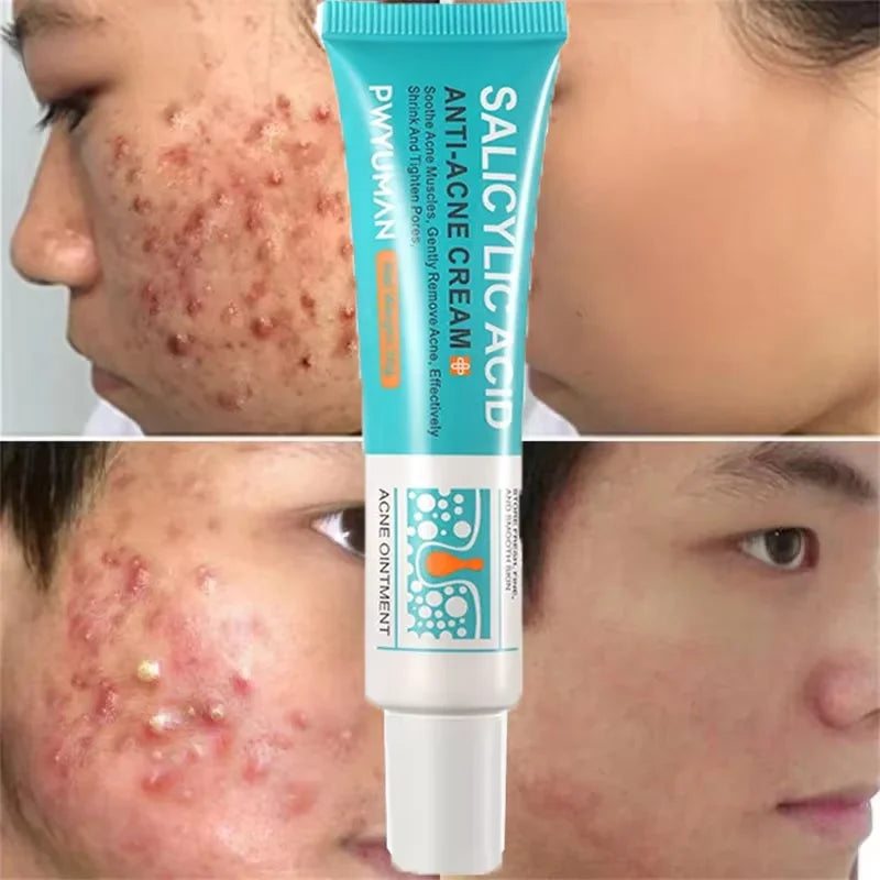Clarifying Salicylic Acid Cleanser - Deep Acne & Pore Purifying Wash