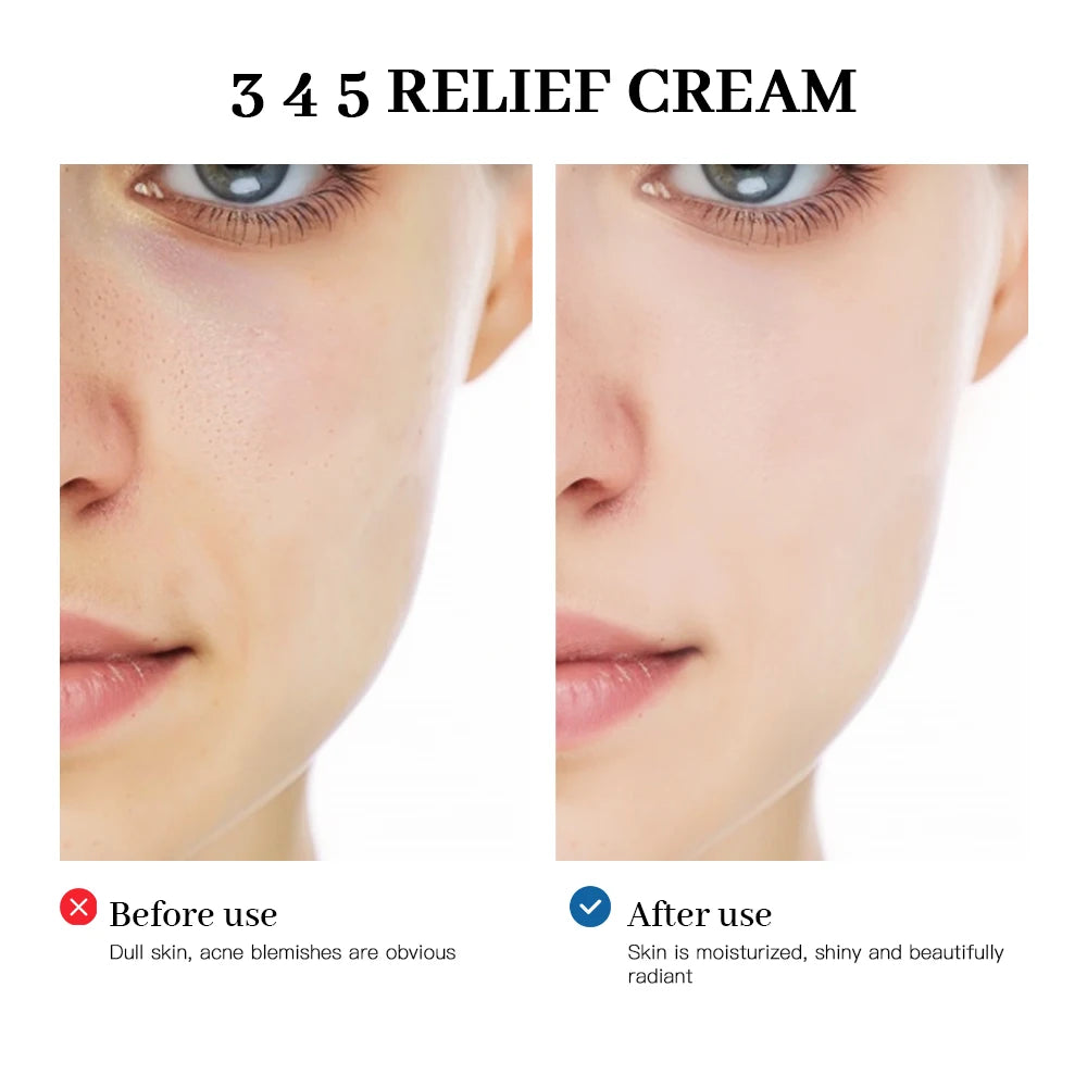 10% Azelaic Acid Cream - Rosacea Relief & Hyperpigmentation Corrector